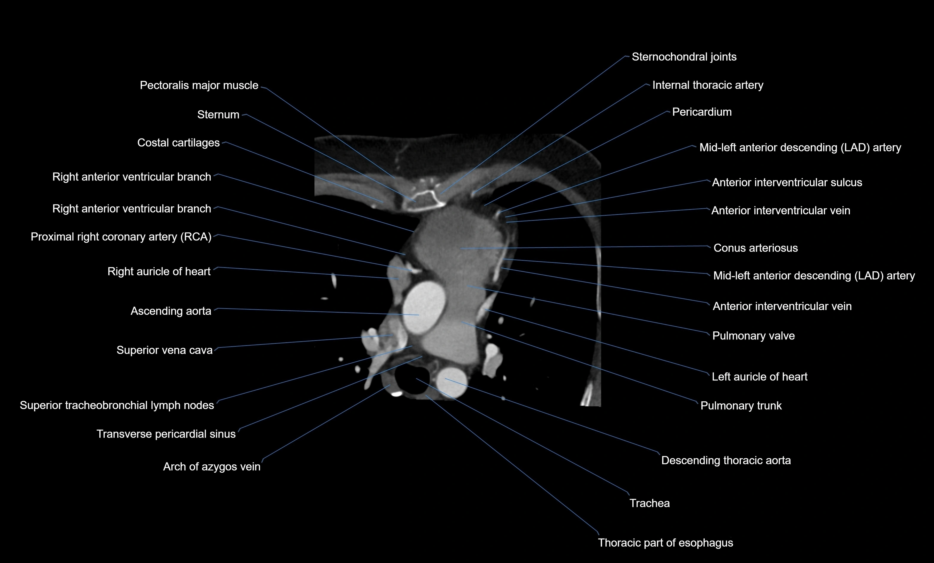 CT heart (coronary angiogram) four chamber view  cross sectional anatomy labelled radiology image -00016.webp